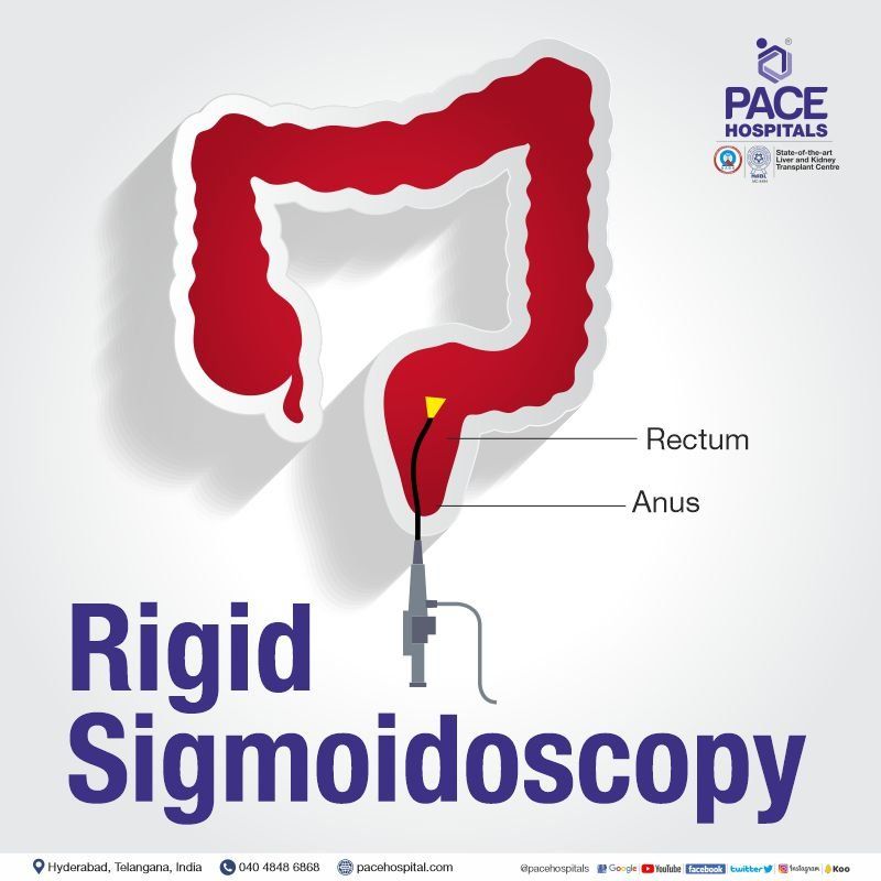 Rigid sigmoidoscopy in Hyderabad | Rigid sigmoidoscopy in India | Rigid sigmoidoscopy procedure | Rigid sigmoidoscopy length