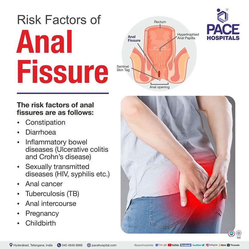 anal fissure risk factors | risks of anal fissures