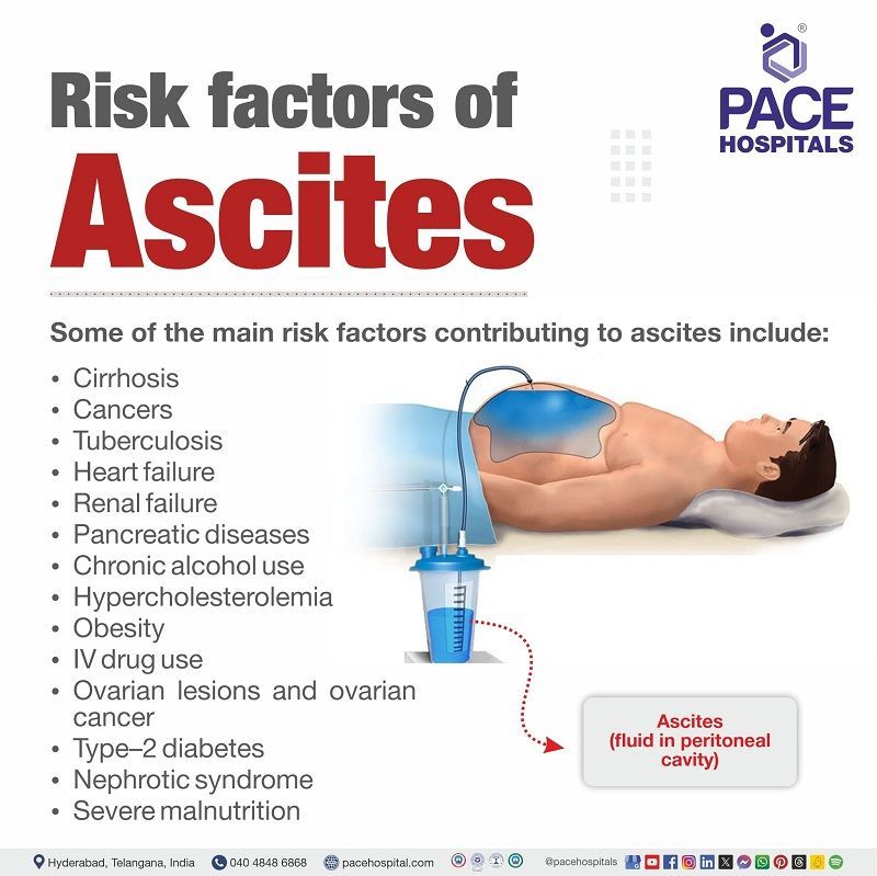 Risk factors of Ascites | Ascites Risk factors | What are the risk factors of Ascites | Visual depicting the main  risk factors contributing to  Ascites