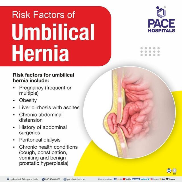 Umbilical hernia - Symptoms, Causes, Complications and Prevention