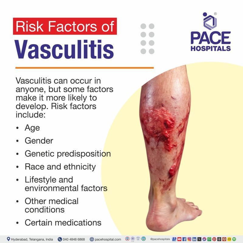 Risk Factors for Vasculitis Risk Factors for Vasculitis | Vasculitis Risk Factors