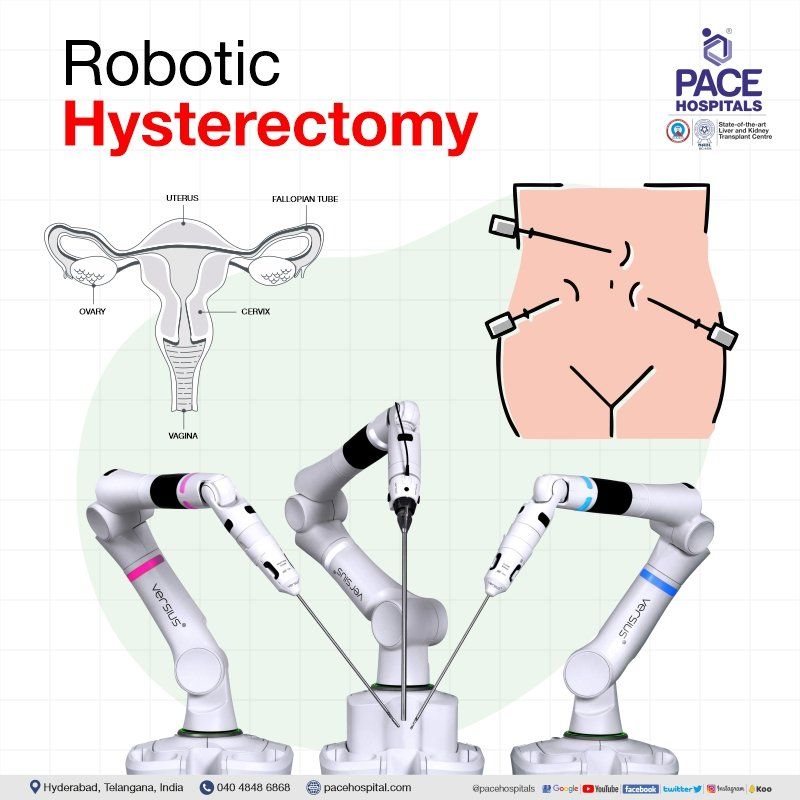 Robotic hysterectomy in Hyderabad | Robotic hysterectomy in India | Robotic hysterectomy surgery | Robotic laparoscopic hysterectomy | Robotic assisted hysterectomy