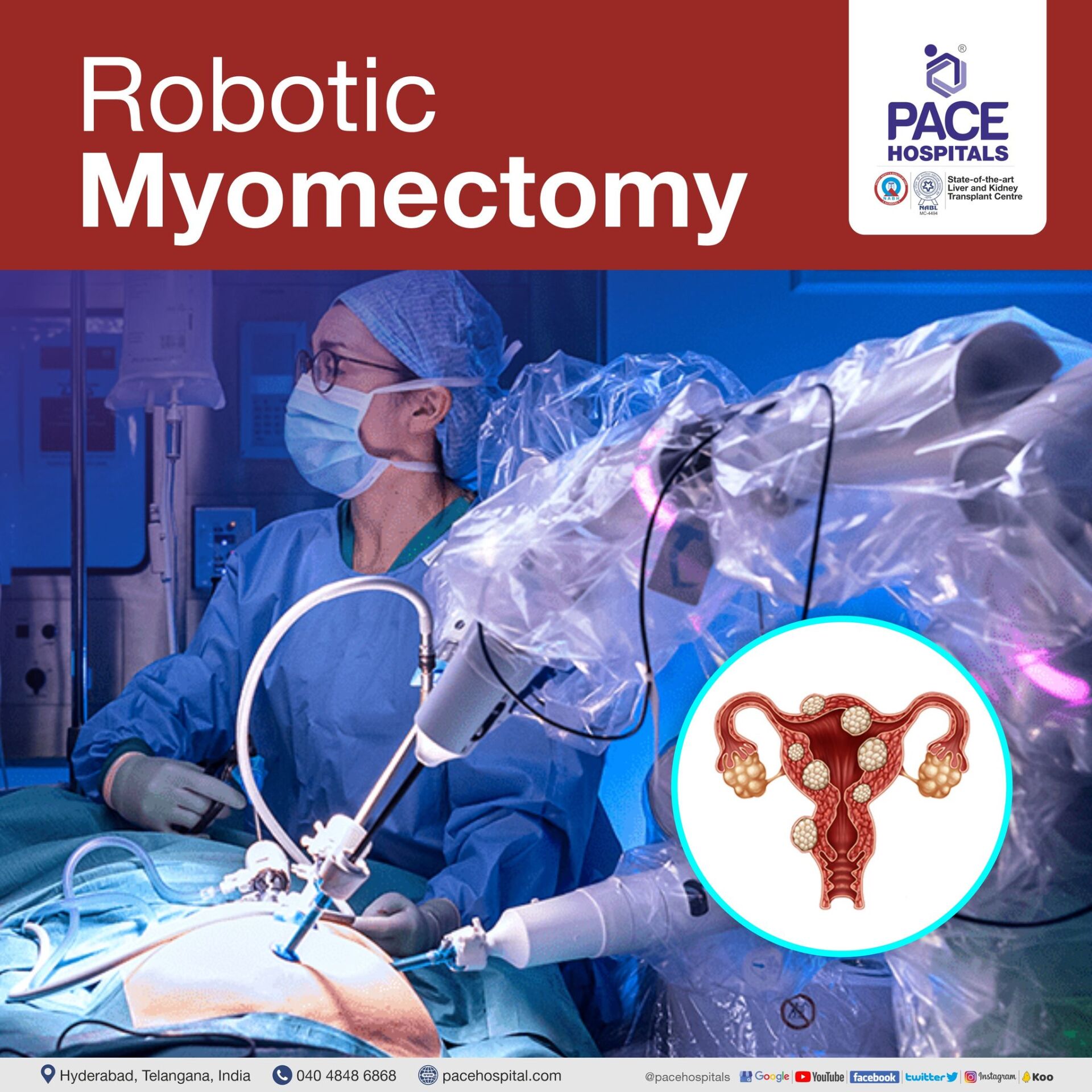 Robotic Myomectomy in Hyderabad | Robotic Myomectomy in India | Robotic Myomectomy cost
