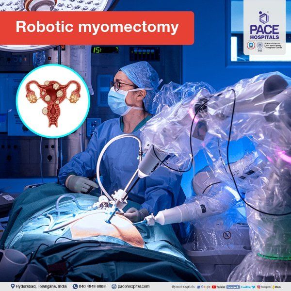Robotic Myomectomy in Hyderabad | Robotic Fibroid Surgery | Uterine Fibroid Surgery