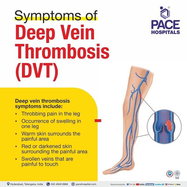 Symptoms and signs of deep vein thrombosis