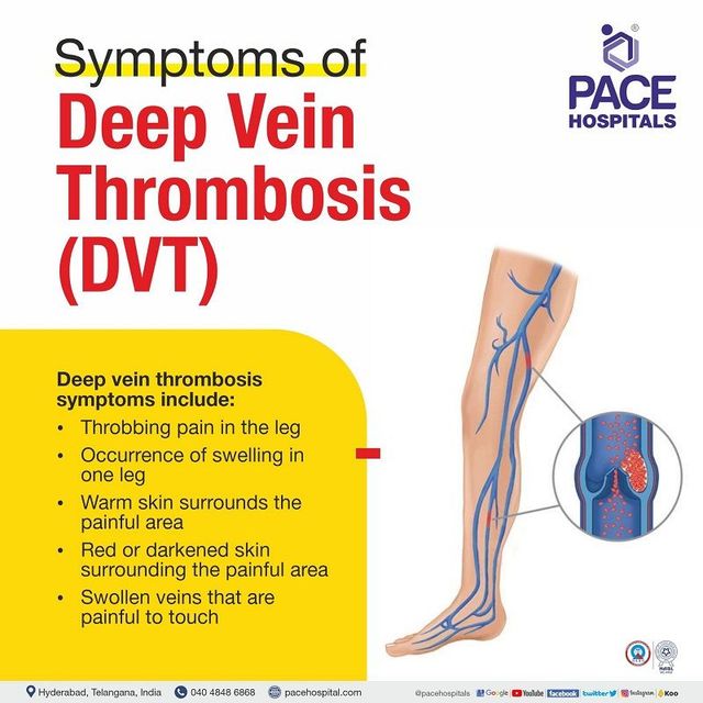 Deep Vein Thrombosis, DVT Symptoms, Causes And, 47% OFF