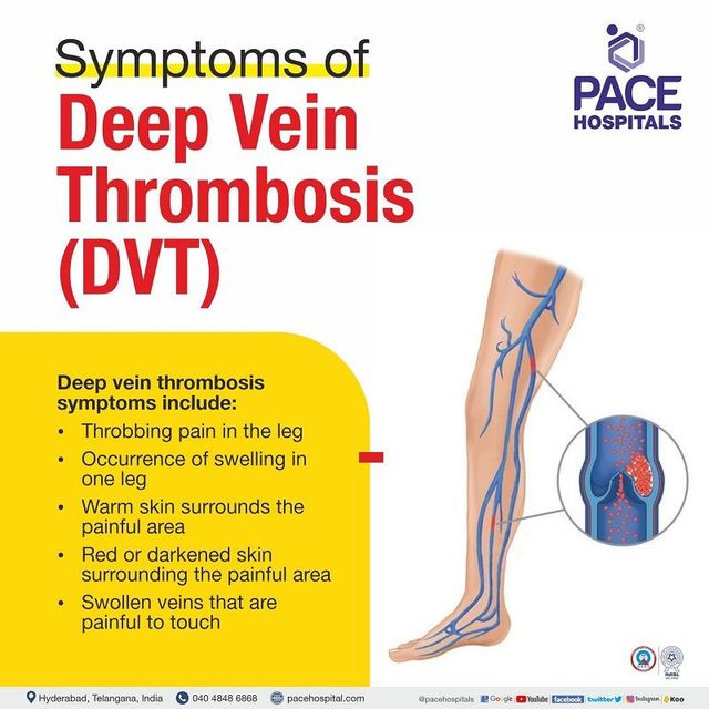Deep Vein Thrombosis DVT Symptoms Causes And 59 OFF