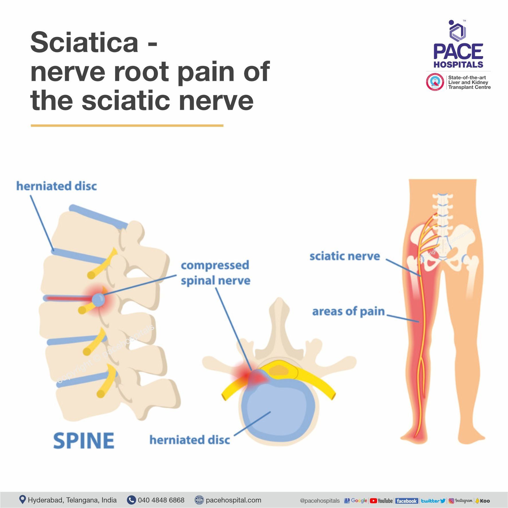 Sciatica (nerve root pain of the sciatic nerve)