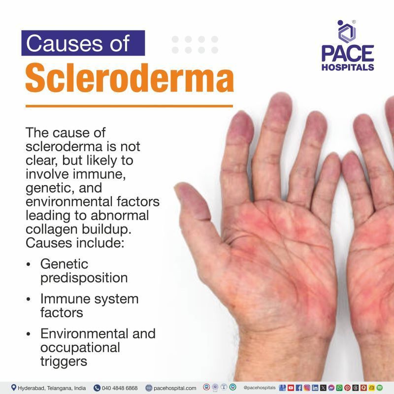 Scleroderma Causes Scleroderma Causes | What causes scleroderma | What causes scleroderma | Causes of Scleroderma