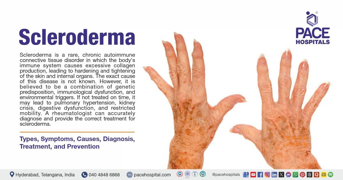 Scleroderma - Symptoms, Causes, Diagnosis, Treatment & Prevention | what is scleroderma