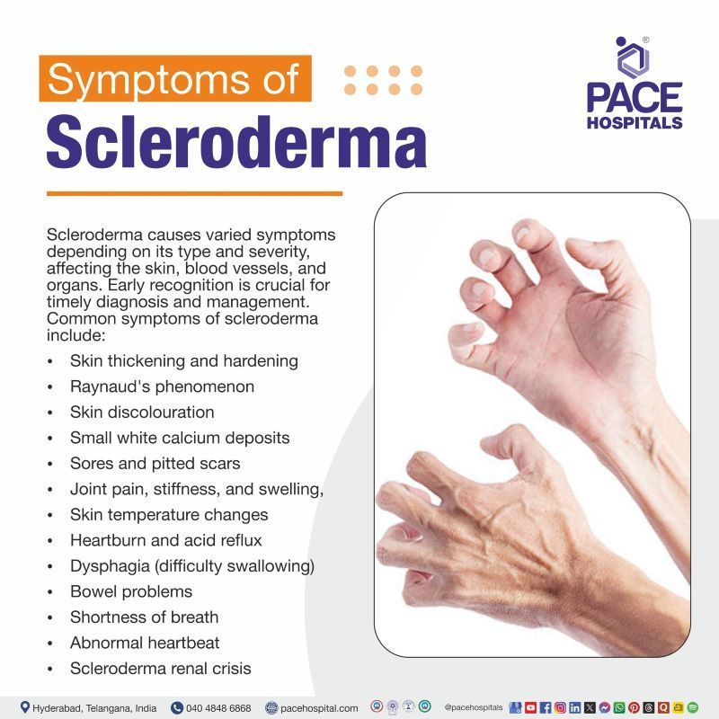 Scleroderma Symptoms Scleroderma Symptoms | Scleroderma signs and symptoms | Symptoms of Scleroderma