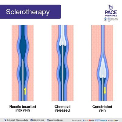 sclerotherapy in hyderabad | varicose vein surgery - sclerotherapy for varicose veins