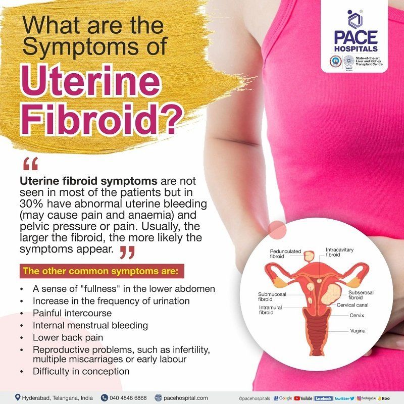 Signs and Symptoms of Uterine Fibroids