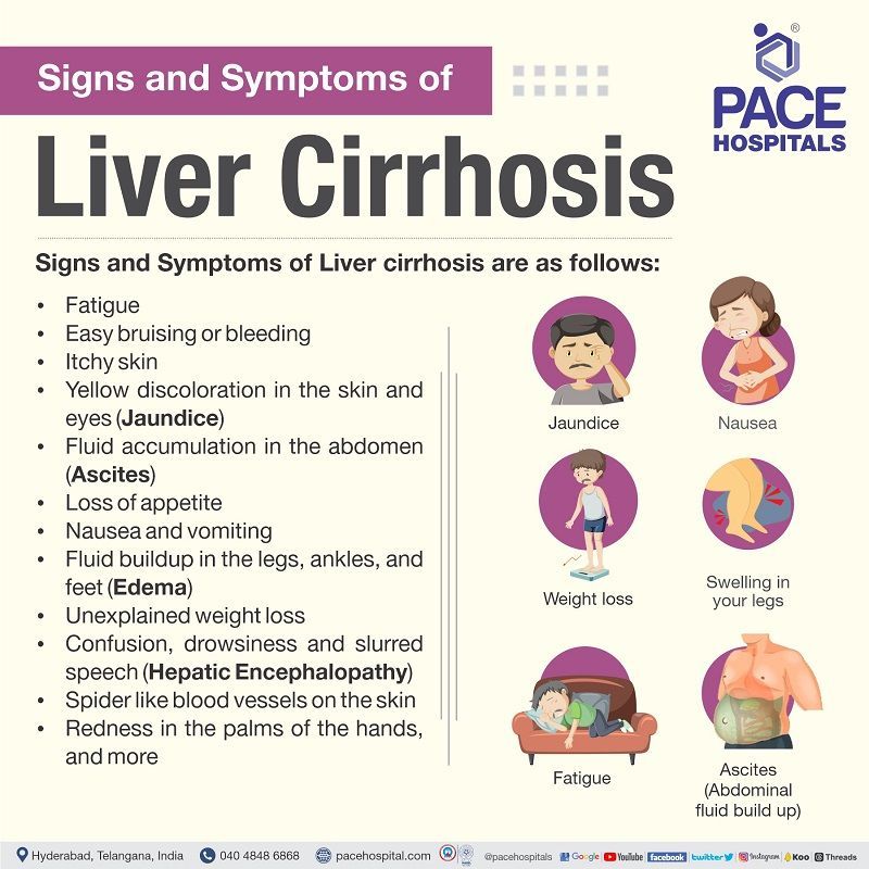 liver cirrhosis symptoms in India | signs of cirrhosis of the liver | signs and symptoms of liver cirrhosis | early signs of liver cirrhosis