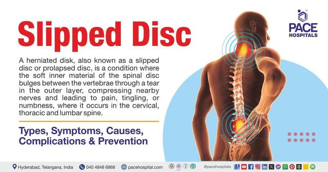 Slipped disc (Herniated disc)- Causes, Symptoms and Treatment