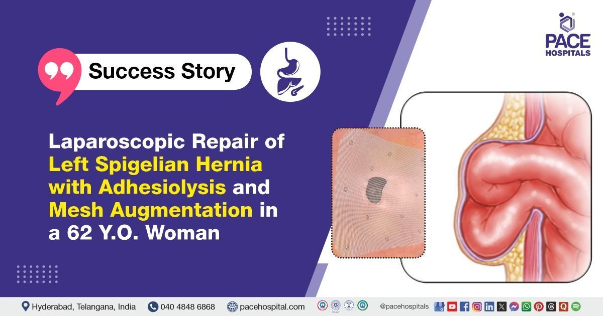 Case study of a woman diagnosed with a left Spigelian hernia, successfully treated at PACE Hospitals