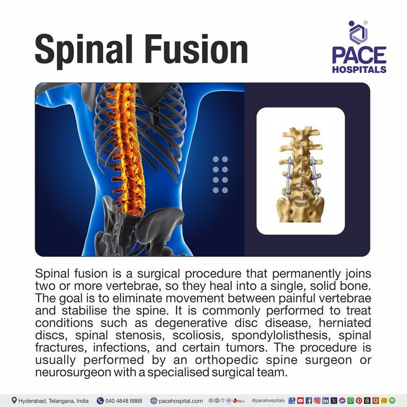 What is Spinal surgery? | Spinal Fusion Surgery Procedure