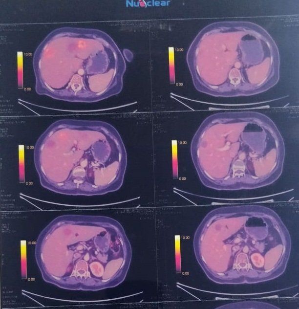 Carcinoma colon with Liver secondaries