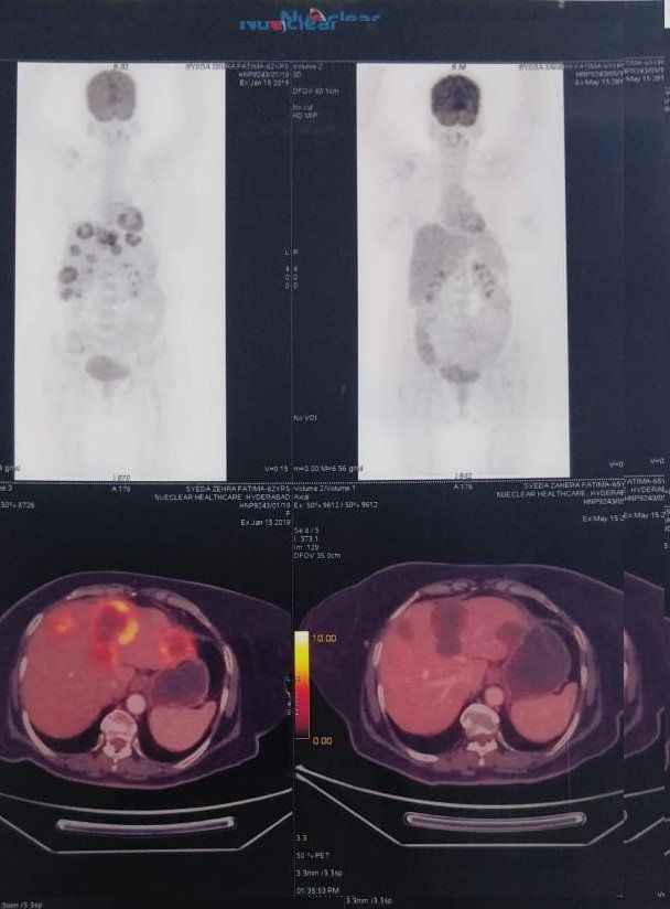 Carcinoma colon with Liver secondaries