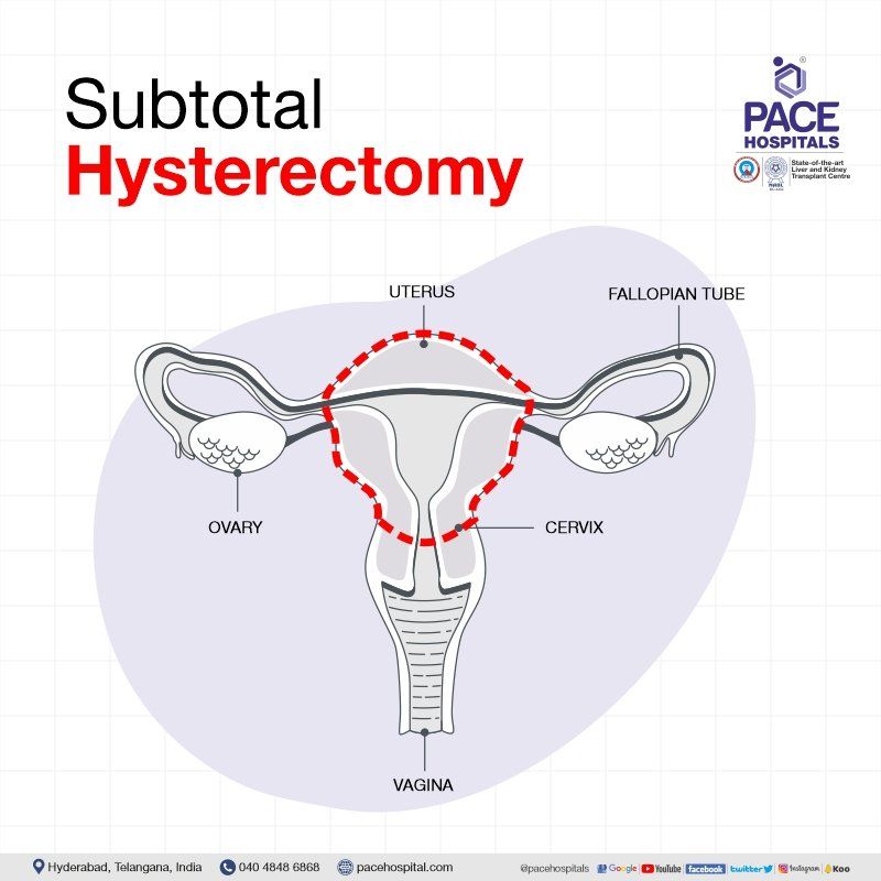 Subtotal hysterectomy in Hyderabad | Subtotal hysterectomy in India | subtotal hysterectomy meaning | partial hysterectomy | partial hysterectomy surgery