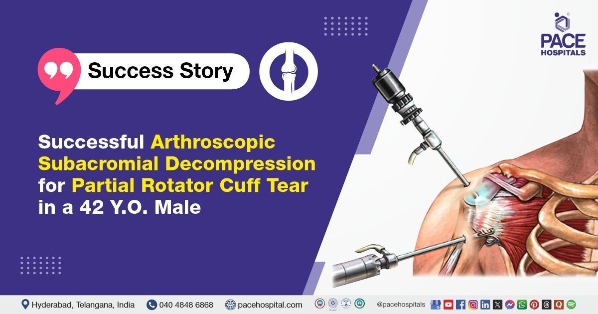 Successful arthroscopic subacromial decompression done for rotator cuff tear at PACE Hospitals