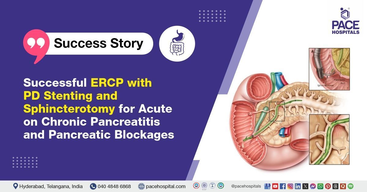 Advanced Endoscopic Treatment for Acute on Chronic Pancreatitis in India | ERCP with PD Stenting