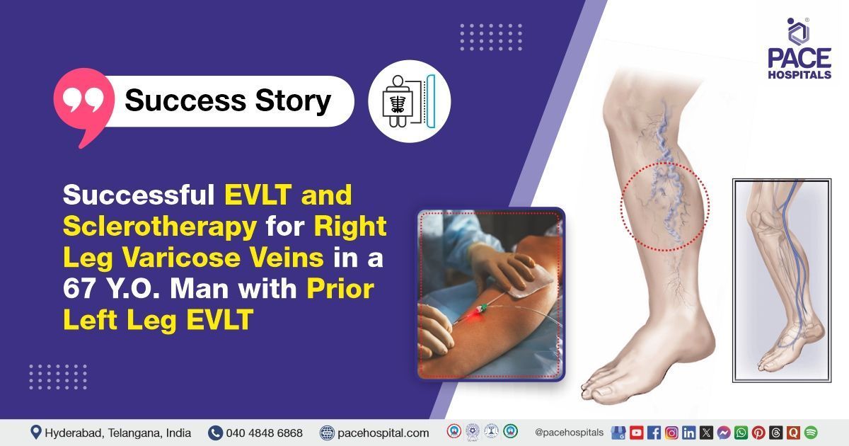 Case study of a Patient treated for Varicose Veins with EVLT & Sclerotherapy at PACE Hospitals