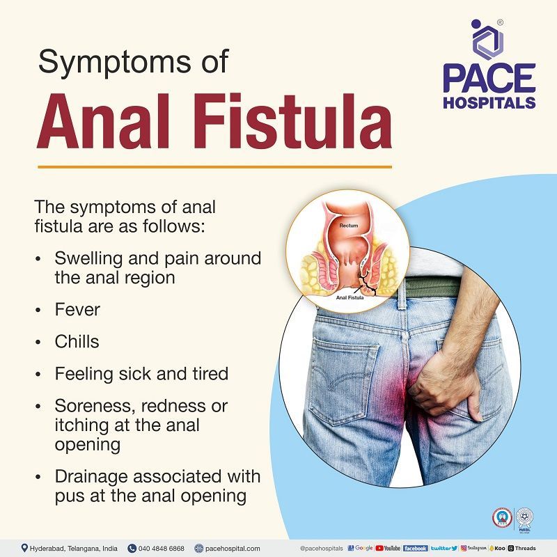 anal fistula symptoms | fistula in ano symptoms and signs | symptoms fistula in ano | signs and symptoms of anal fistula | what are the anal fistula signs and symptoms