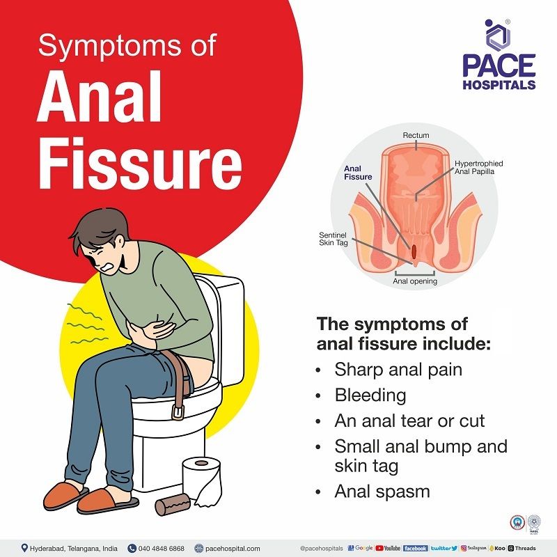 anal fissure symptoms | signs of anal fissure | symptoms for anal fissures | what is the symptoms of anal fissure