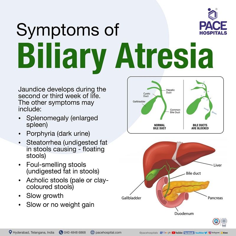 biliary atresia symptoms and signs