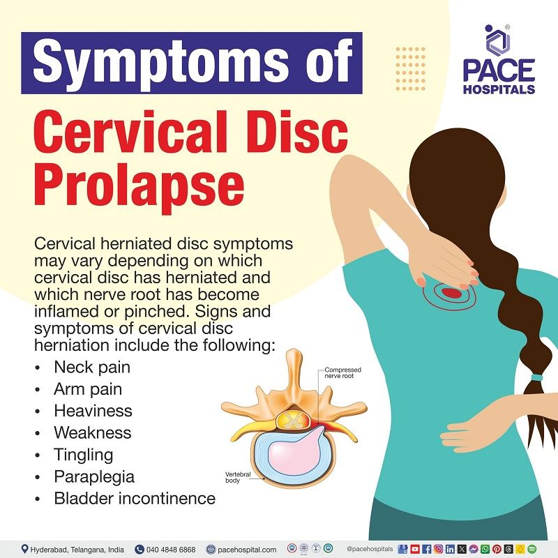 Cervical disc prolapse symptoms | symptoms of Cervical disc prolapse | cervical disc prolapse symptoms and signs | Visual depicting the symptoms of cervical disc prolapse