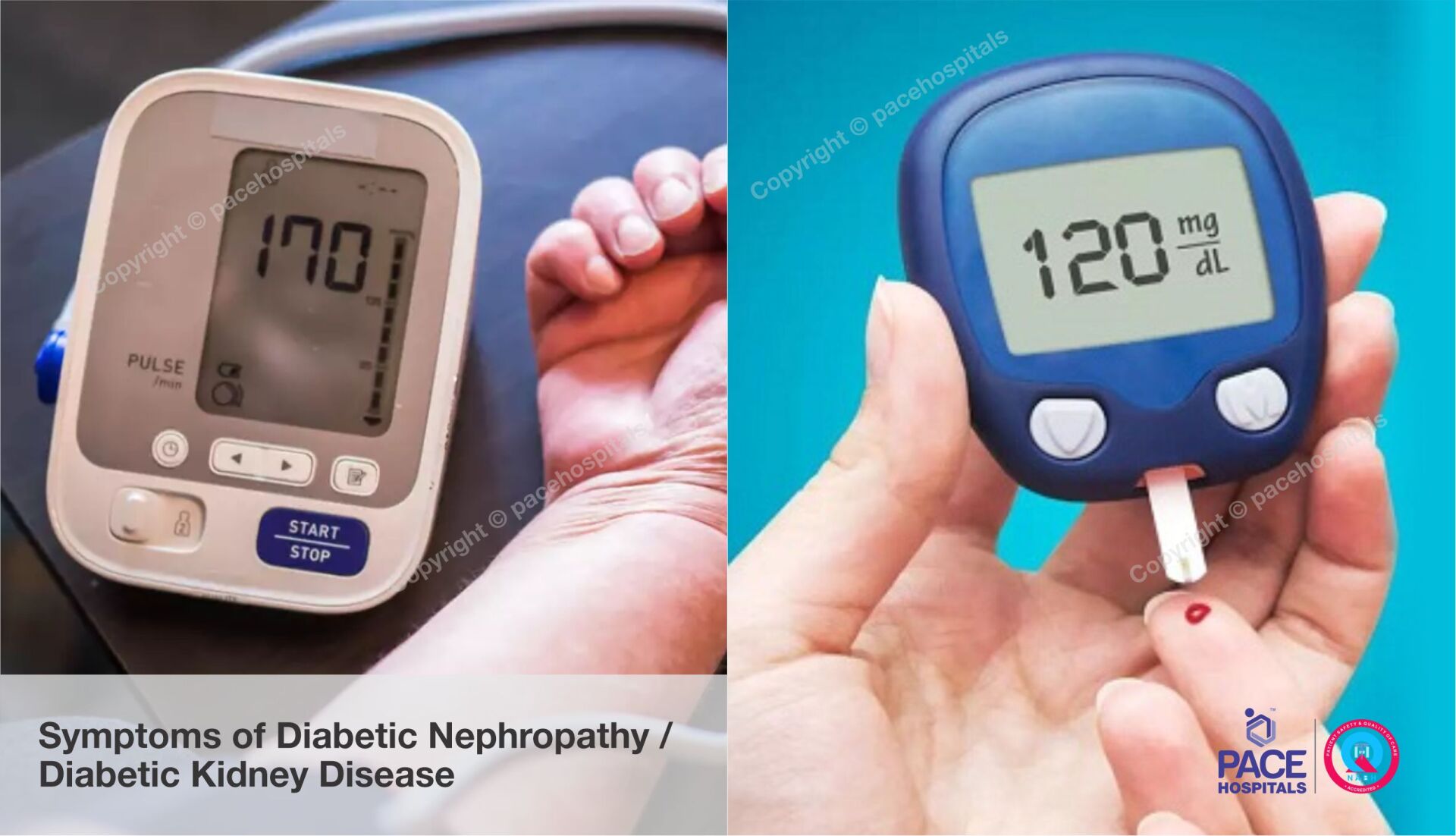 signs and symptoms of Diabetic Nephropathy, Diabetic Kidney Disease