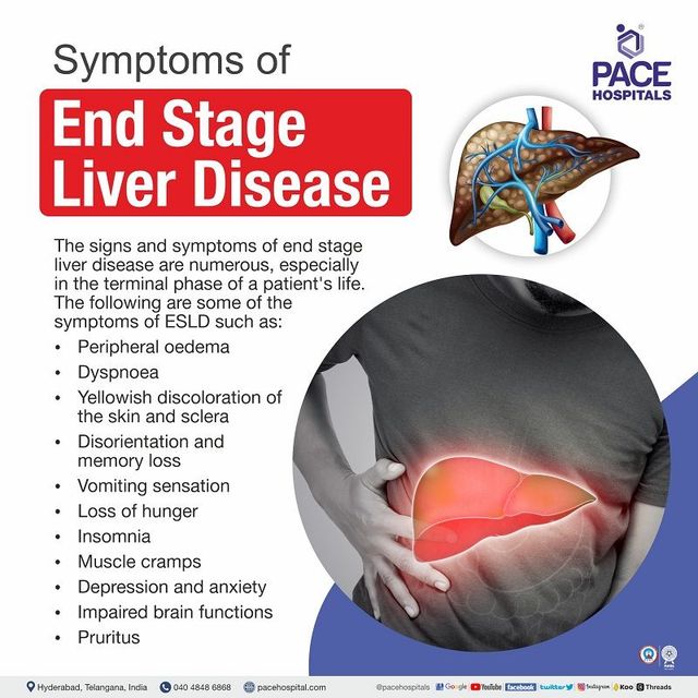 What Is End Stage Liver Disease Liver Disease At 41 OFF