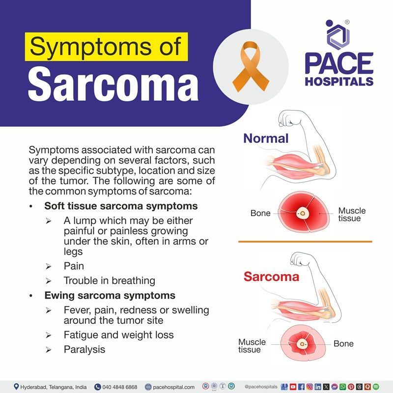 Sarcoma symptoms | Visual depicting the various sarcoma symptoms