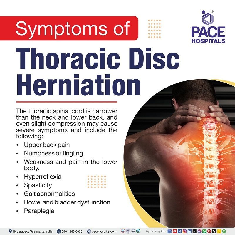 thoracic herniated disc symptoms | thoracic spine herniated disc symptoms | symptoms of herniated disc in upper thoracic spine | Visual outlining the symptoms of thoracic herniated disc
