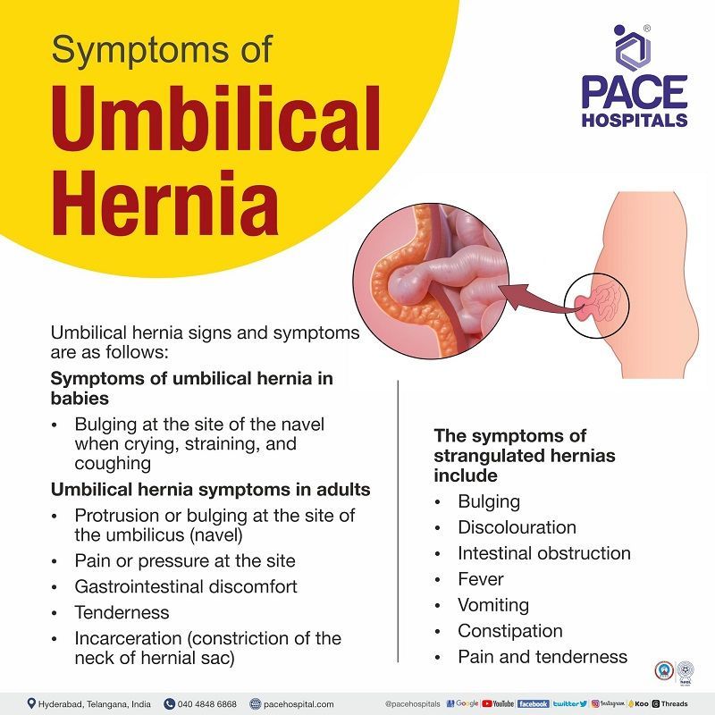 symptoms of umbilical hernia, India | signs of umbilical hernia | umbilical hernia symptoms in newborns | symptoms of umbilical hernia in adults | strangulated umbilical hernia symptoms | paraumbilical hernia symptoms