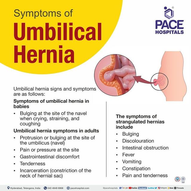 Signs and Symptoms of Umbilical Hernia