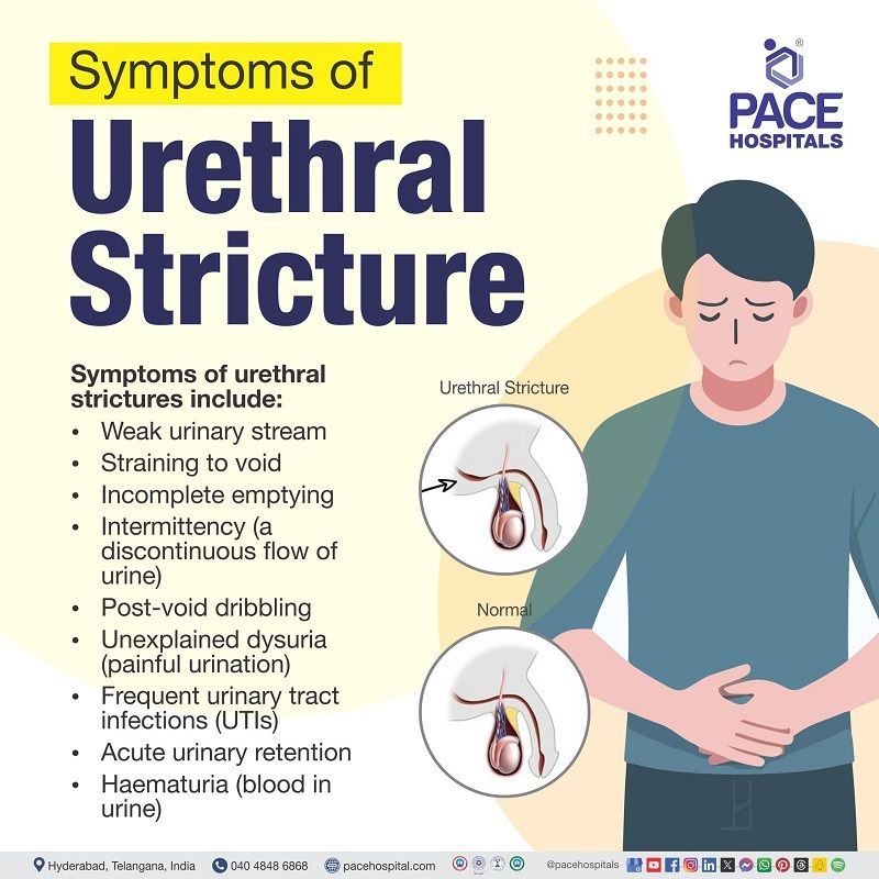 urethral stricture symptoms | Symptoms of urethral stricture | urethral stricture female symptoms | bulbar urethral stricture symptoms | Visual depicting the symptoms of Urethral stricture 