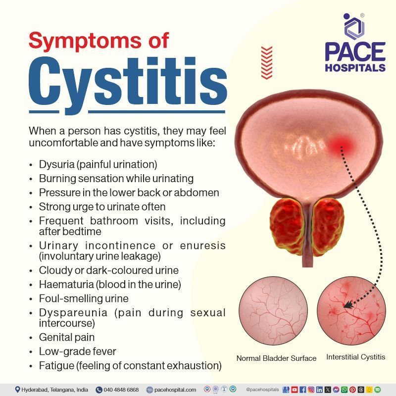 cystitis symptoms | interstitial cystitis symptoms | cystitis symptoms in females | acute cystitis symptoms | Visual citing the symptoms of cystitis