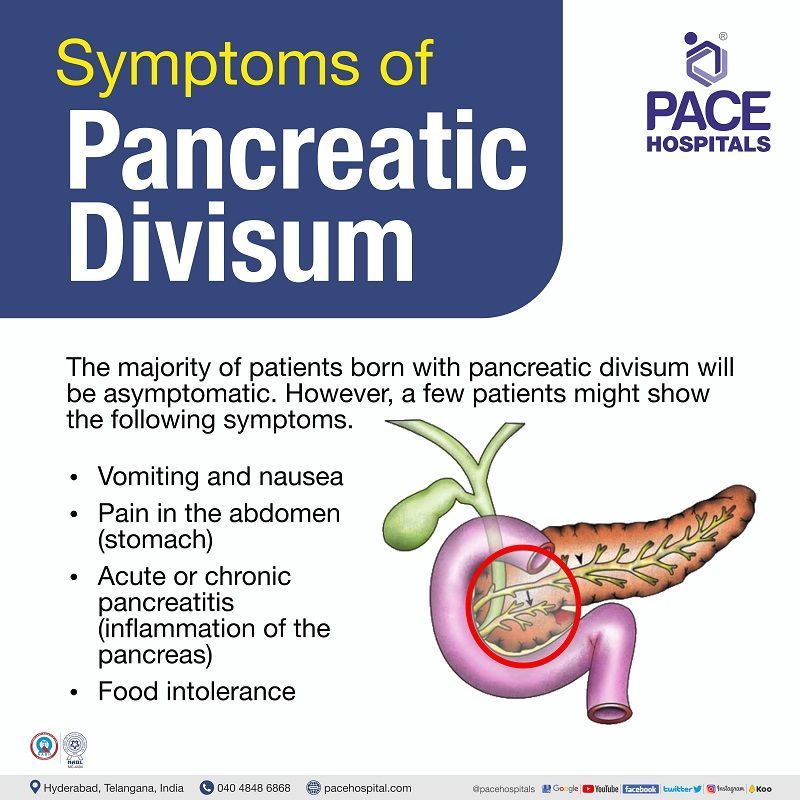 pancreas divisum symptoms treatment | pancreas divisum symptoms | pancreas divisum treatment in Hyderabad