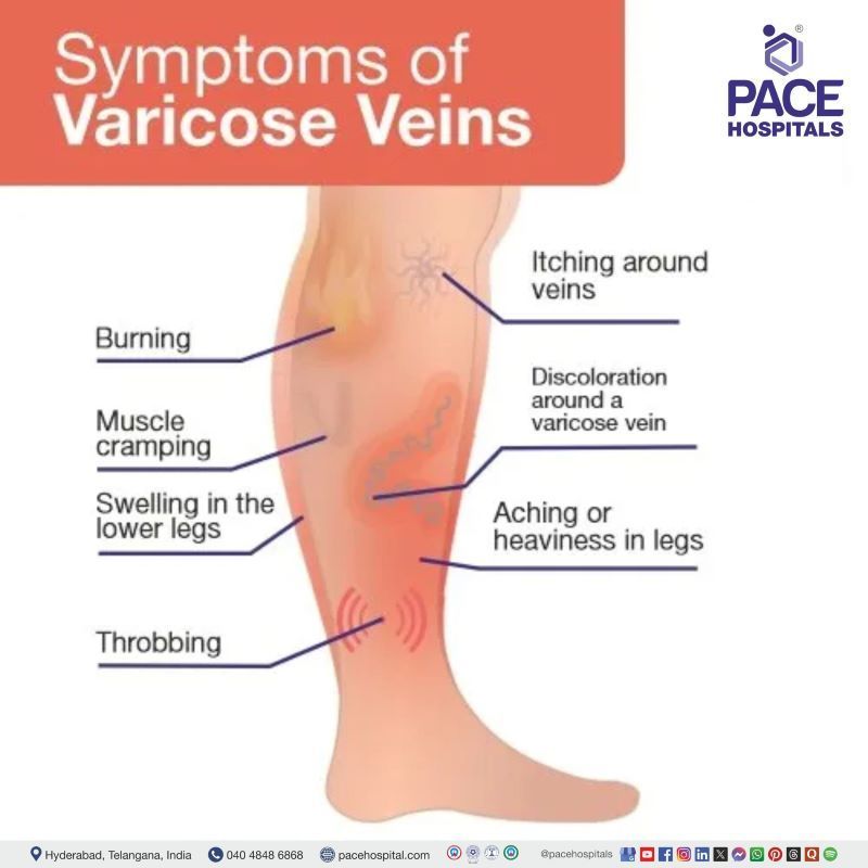 Varicose Veins Symptoms varicose veins symptoms | symptoms of varicose veins