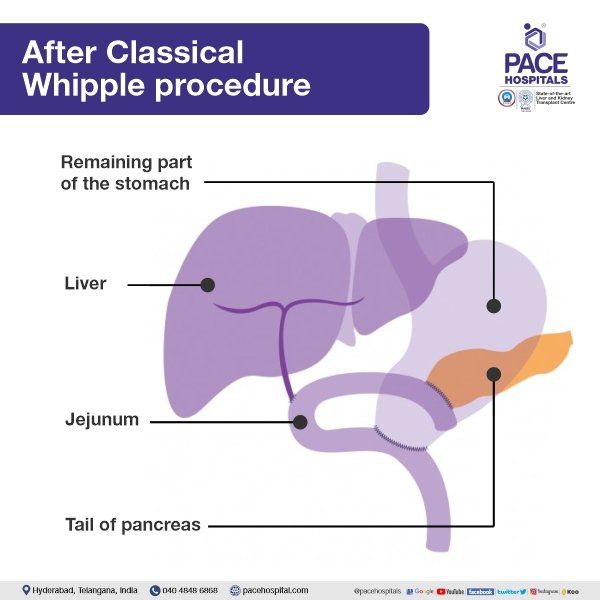 Best Hospital for Whipple Procedure in Hyderabad | Surgery and Cost