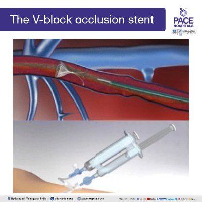 V-block stent |  V-block occlusion for varicose veins treatment in hyderabad | varicose vein surgery