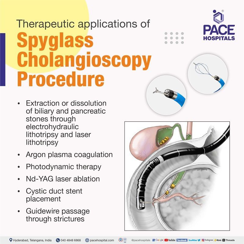 Therapeutic Indications for Spyglass Cholangioscopy Procedure | Best Hospital for Spyglass Cholangioscopy Procedure in Hyderabad, India