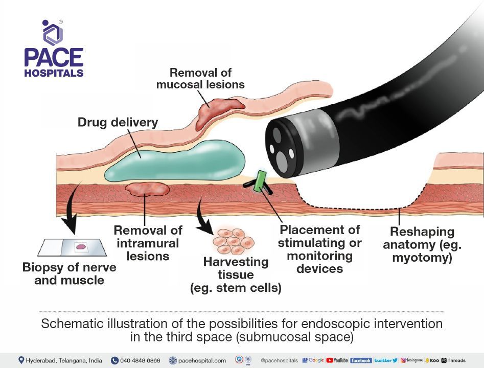 Third space endoscopy indications | Third Space Endoscopy technique in Hyderabad, India | possibilities for endoscopic intervention in the third space