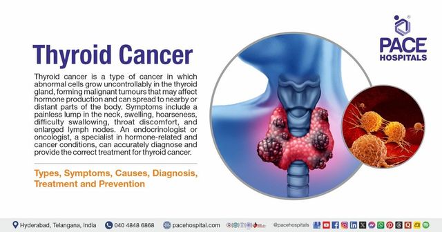 Thyroid Cancer Explore vol.3 no.2(2201 「Thyroid Cancer Expl Thyroid Cancer: Types, Symptoms, Causes, Diagnosis & Treatment