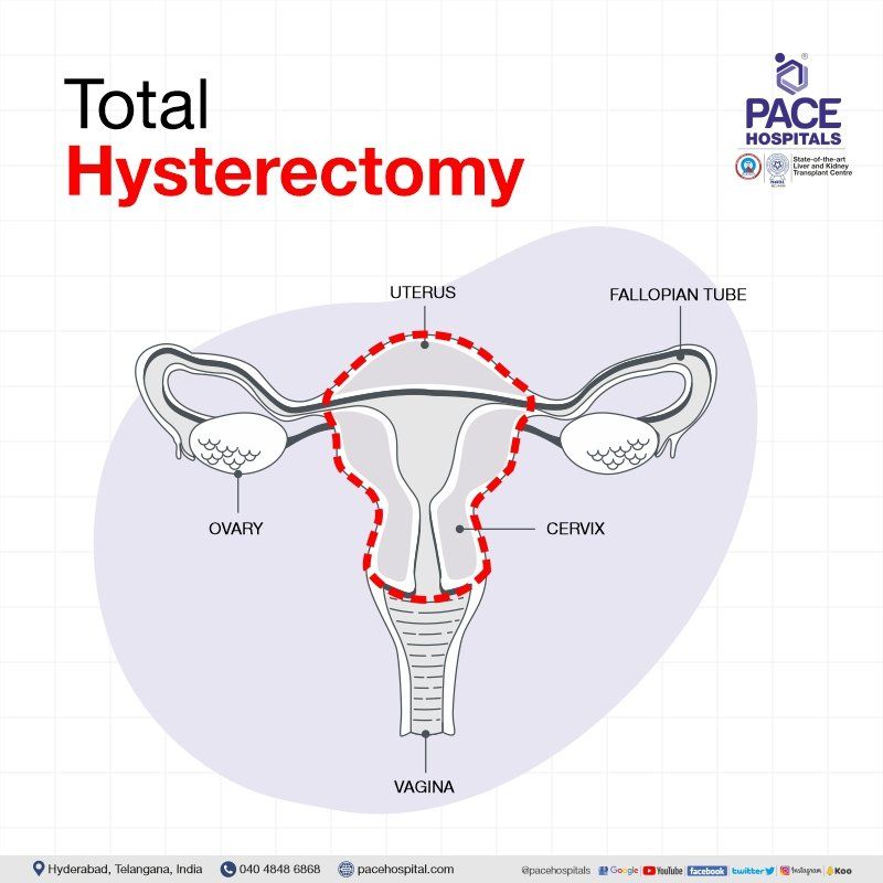 Total hysterectomy in Hyderabad | Total hysterectomy in India | Total abdominal hysterectomy | Total laparoscopic hysterectomy | Total hysterectomy surgery
