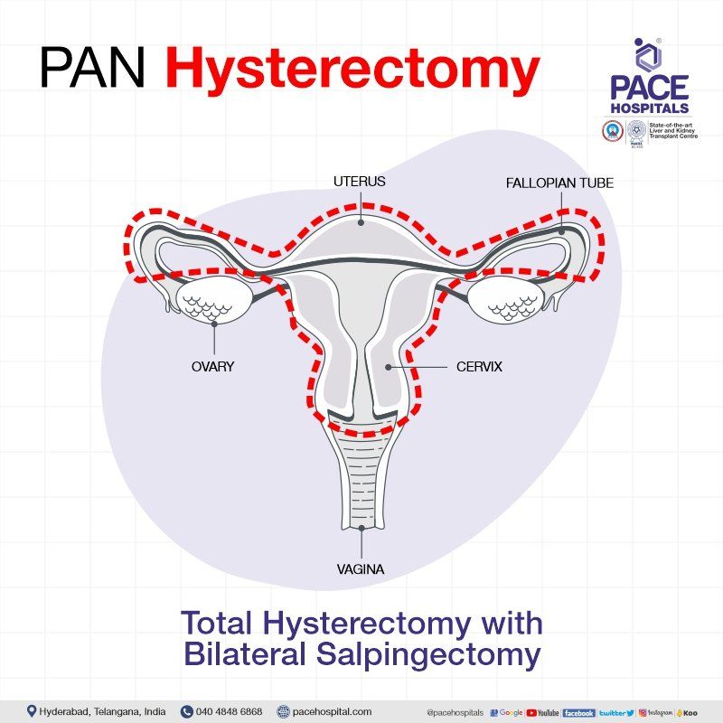 Pan hysterectomy in Hyderabad | Pan hysterectomy in India | Bilateral Salpingectomy | Laparoscopic bilateral salpingectomy | Total laparoscopic hysterectomy with bilateral salpingectomy