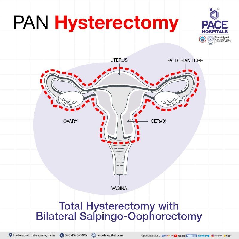 Pan hysterectomy in Hyderabad | Pan hysterectomy in India | Bilateral salpingo oophorectomy | Bilateral oophorectomy | Salpingooophorectomy | Total abdominal hysterectomy bilateral salpingo oophorectomy