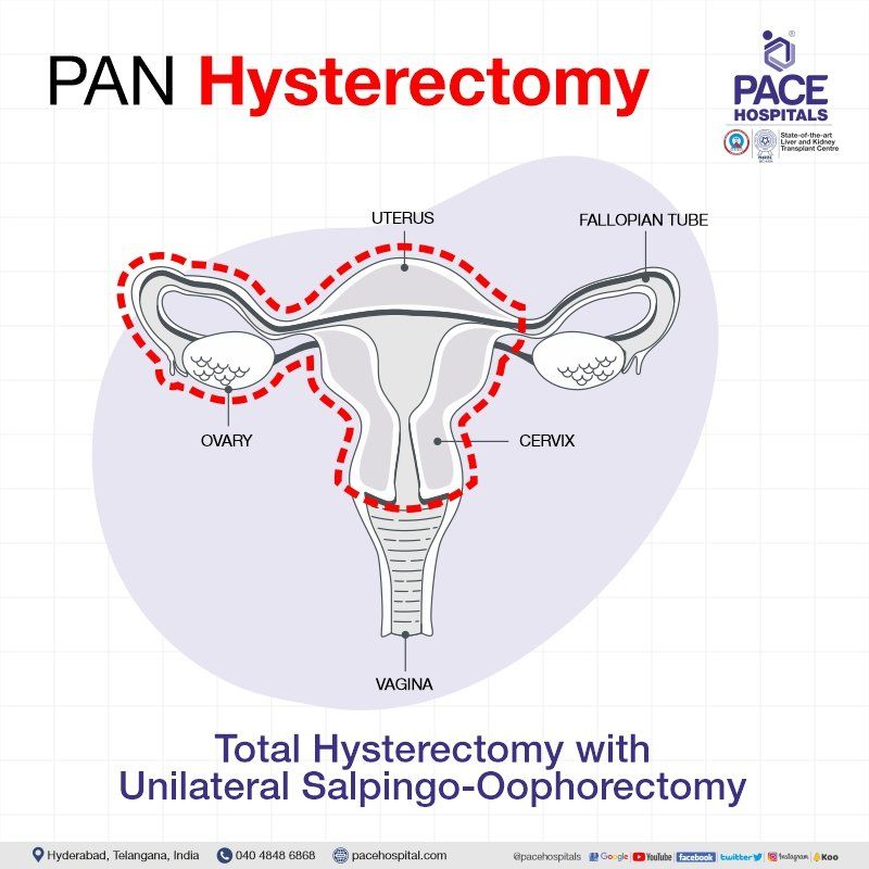 Pan hysterectomy in Hyderabad | Pan hysterectomy in India | Unilateral salpingo oophorectomy | oophorectomy unilateral | salpingooophorectomy | Hysterectomy with salpingo oophorectomy